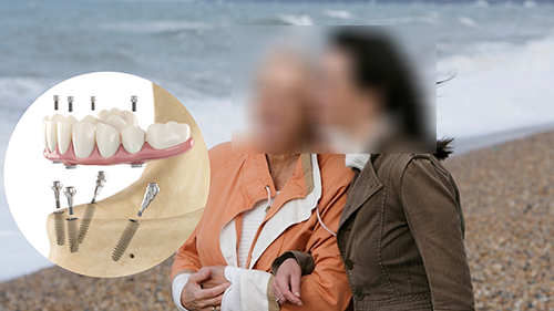 Ankylos 德国费亚丹种植体 Ankylos 德国费亚丹种植体